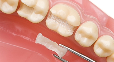 dental fillings and repairs - naco dentist - 3d dental center