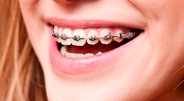 orthodontics-3ddental-naco-mexico