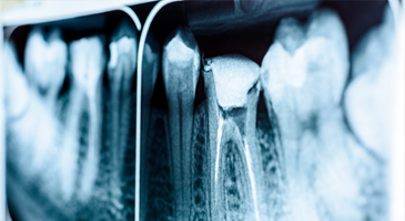 root-canal-3ddental-365x200px