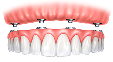 full-dentures-bisbee-365x200